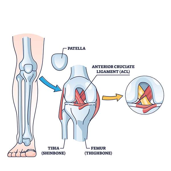 ACL reconstruction Surgeon