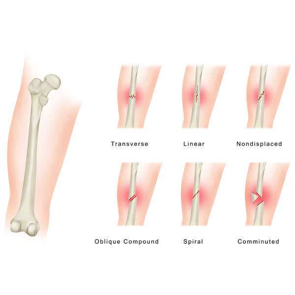 Bone fracture Surgeon