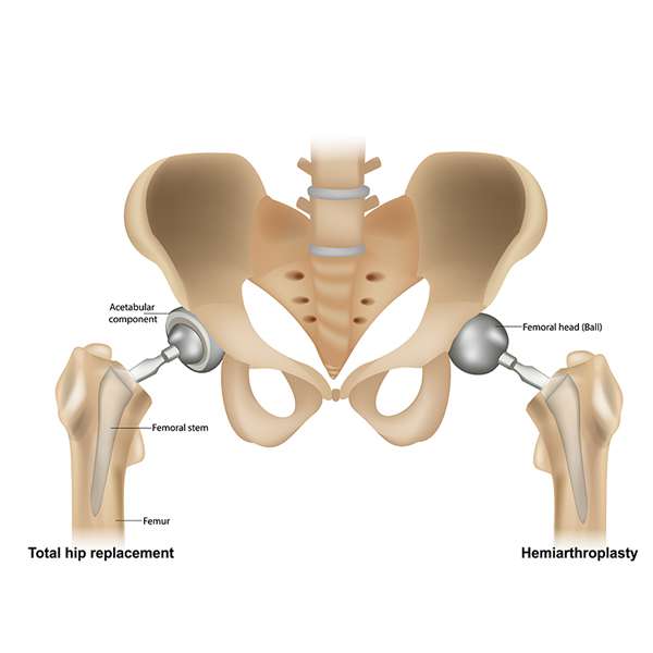 Hip replacement Surgeon