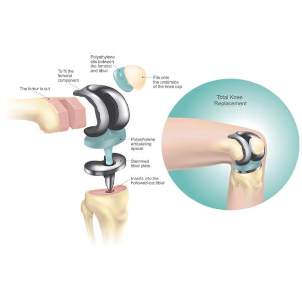 Knee replacement Surgeon